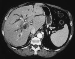 Cholangiocarcinoma - CTisus CT Scan