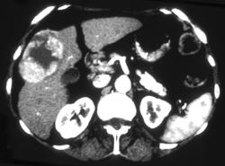 Hepatoma - CTisus CT Scan