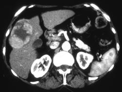 Hepatoma - CTisus CT Scan