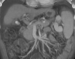 Patent Superior Mesenteric Vein (SMV) and Portal Vein (PV) - CTisus CT Scan