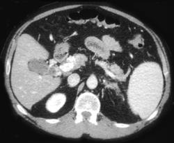 Cavernous Transformation of the Portal Vein Simulates A Mass on Arterial Phase Images - CTisus CT Scan