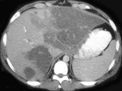 Focal Fatty Infiltration of the Liver - CTisus CT Scan