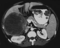 Metastatic Ovarian Cancer - CTisus CT Scan