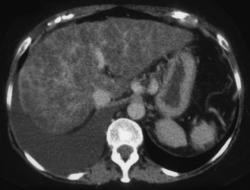 Biliary Cirrhosis - CTisus CT Scan