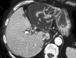 Liver Infarct - CTisus CT Scan