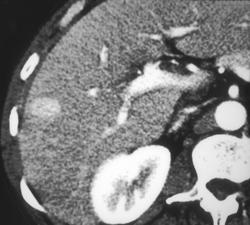 Hepatoma Only Seen on Early Phase Images - CTisus CT Scan