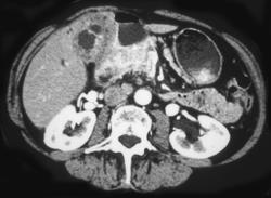 Gallbladder Cancer With Nodes - CTisus CT Scan