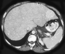 Hepatoma in A Cirrhotic Liver - CTisus CT Scan