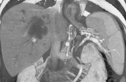 Cholangiocarcinoma - CTisus CT Scan