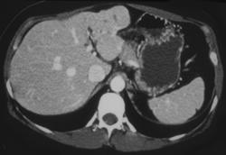 Focal Nodular Hyperplasia (FNH) - CTisus CT Scan