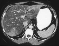 Fatty Liver - CTisus CT Scan