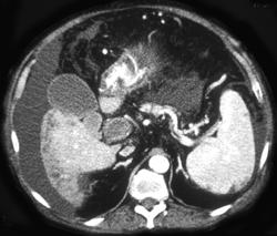 Cirrhosis With Portal Vein Thrombosis - CTisus CT Scan