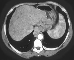 Huge Varices Seen Best on Venous Phase - CTisus CT Scan