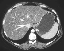 Fatty Liver With Gastric Varices - CTisus CT Scan