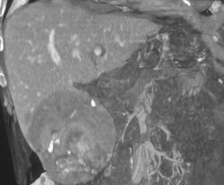 Hepatoma - CTisus CT Scan