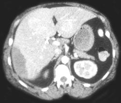 Subcapsular Bleed Due to Hepatic Adenomas - CTisus CT Scan