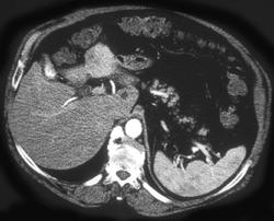 Hepatoma - CTisus CT Scan