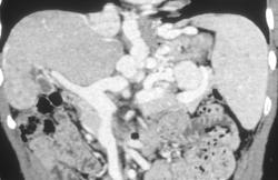 Cirrhosis With Large Gastric and Esophageal Varices - CTisus CT Scan