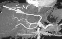 Normal Hepatic Artery - CTisus CT Scan