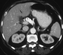 Hepatic Artery Aneurysm - CTisus CT Scan