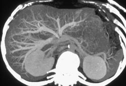 Normal Liver Anatomy - CTisus CT Scan