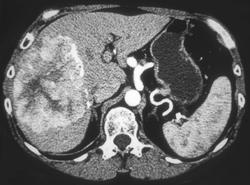 Hepatoma - CTisus CT Scan
