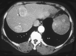 Metastatic Islet Cell Tumor - CTisus CT Scan