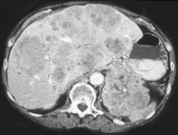 Adrenal Cancer With Liver Metastases - CTisus CT Scan