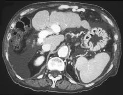 Cirrhosis With Dilated Umbilical Vein - CTisus CT Scan