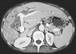 Cholangiocarcinoma - CTisus CT Scan