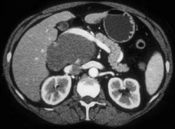 Porta Caval Nodes Simulate A Liver Mass - CTisus CT Scan