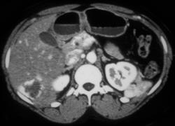 Hemangioma - CTisus CT Scan