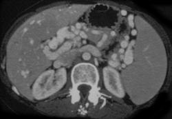 Cavernous Transformation With Portal Vein Thrombosis - CTisus CT Scan