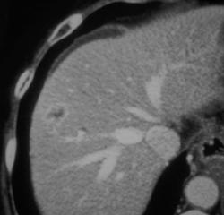 1 Cm Hepatoma With Flow Related Changes - CTisus CT Scan