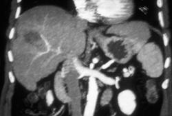 Liver Metastases - CTisus CT Scan
