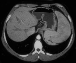 Dual Phase With Large Varices - CTisus CT Scan