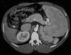 Huge Perisplenic Varices in Cirrhosis - CTisus CT Scan
