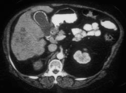 Hepatoma - CTisus CT Scan