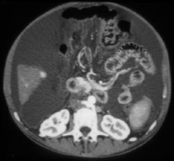 Multiple Small Hepatomas - CTisus CT Scan