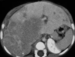Hepatoma - CTisus CT Scan
