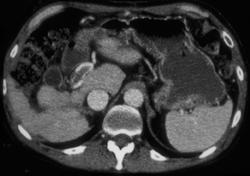Mesocaval Shunt Due to Portal Vein Thrombosis - CTisus CT Scan