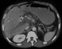 Portal Vein Thrombosis With Cavernous Transformation of the Portal Vein (CTPV) - CTisus CT Scan