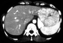 Focal Nodular Hyperplasia (FNH) With Central Scar - CTisus CT Scan