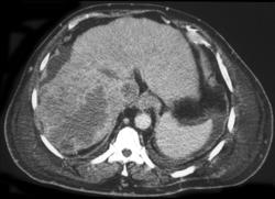 Hepatoma Grows Into IVC and Right Atrium - CTisus CT Scan
