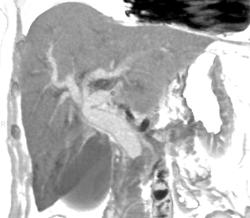 Ampullary Cancer - CTisus CT Scan