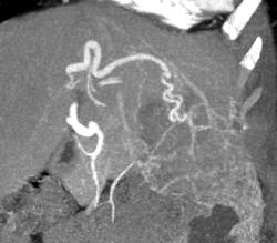 Hepatoma - CTisus CT Scan