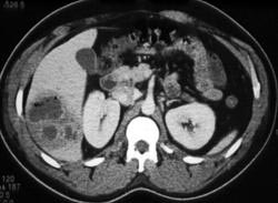 Liver Abscess - CTisus CT Scan