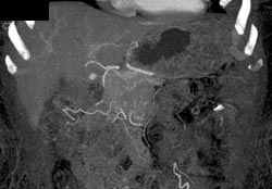 Hepatoma (1 Cm) - CTisus CT Scan