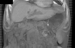 Dilated Ducts in Left Lobe Liver Due to Cholangiocarcinoma - CTisus CT Scan