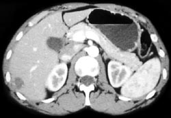 Hemangioma - CTisus CT Scan